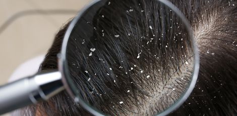 dandruff-090226